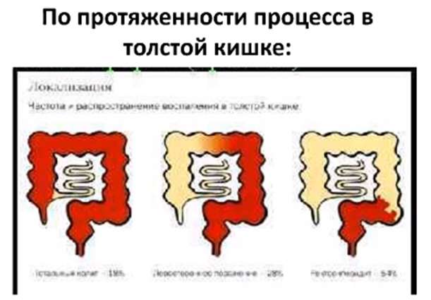 По протяжённости процесса в толстой кишке ЯК