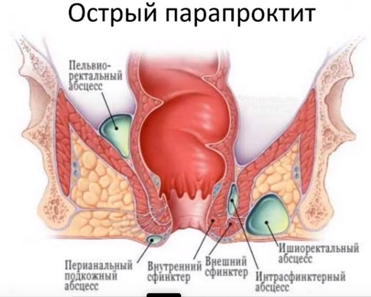 Острый парапроктит