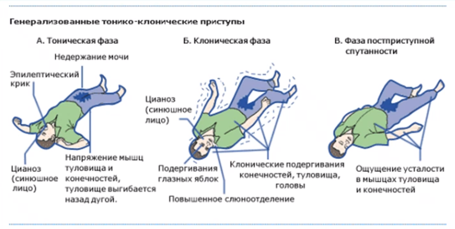Фазы генерализованных тонико-клонических приступов