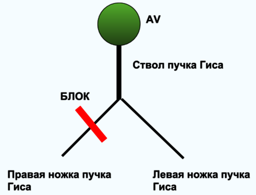 Блокада ножки пучка Гиса