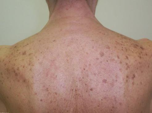 Лентиго