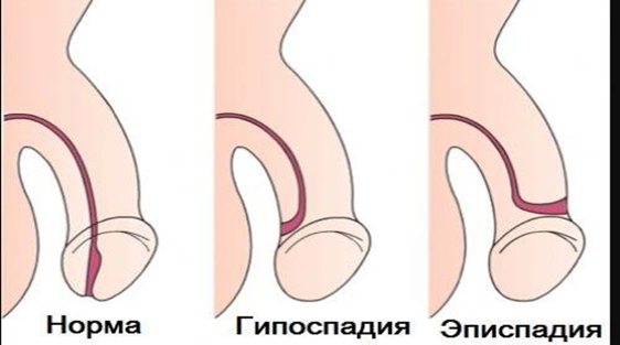 Мальформации пениса