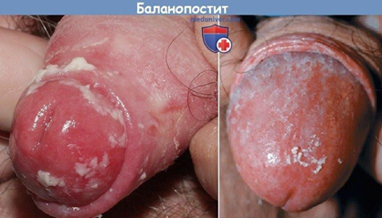 Баланит, баланопостит
