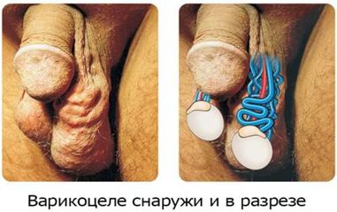 Варикоцеле