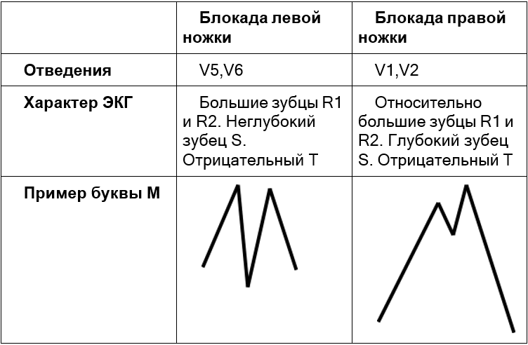 Табличка некоторых отличий левых и правых блокад ножек пучка Гиса